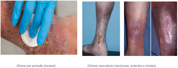 Úlcera por pressão (escara)