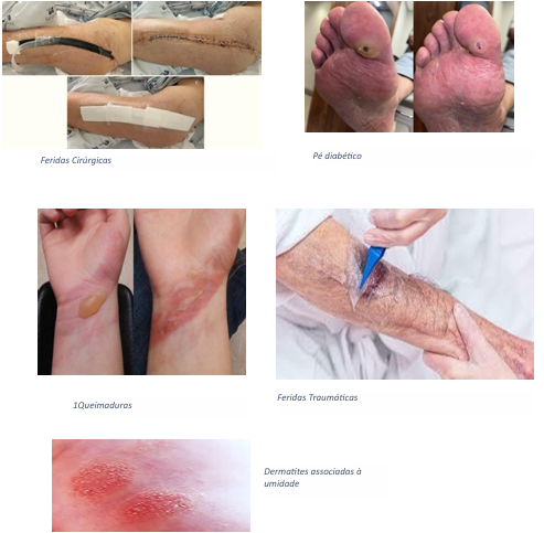 Úlceras vasculares (varicosas, arteriais e mistas)